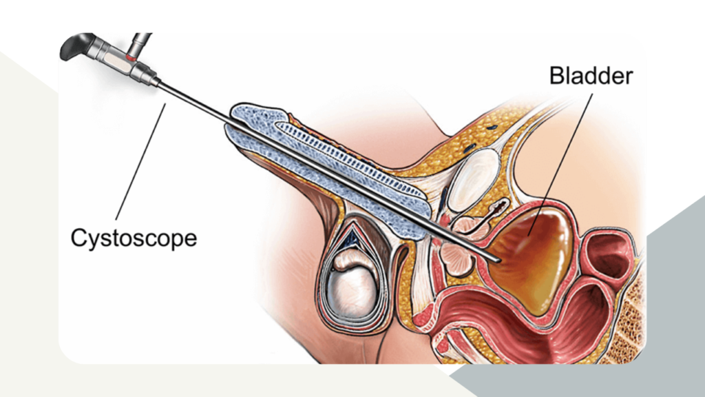 Cystoscopy image