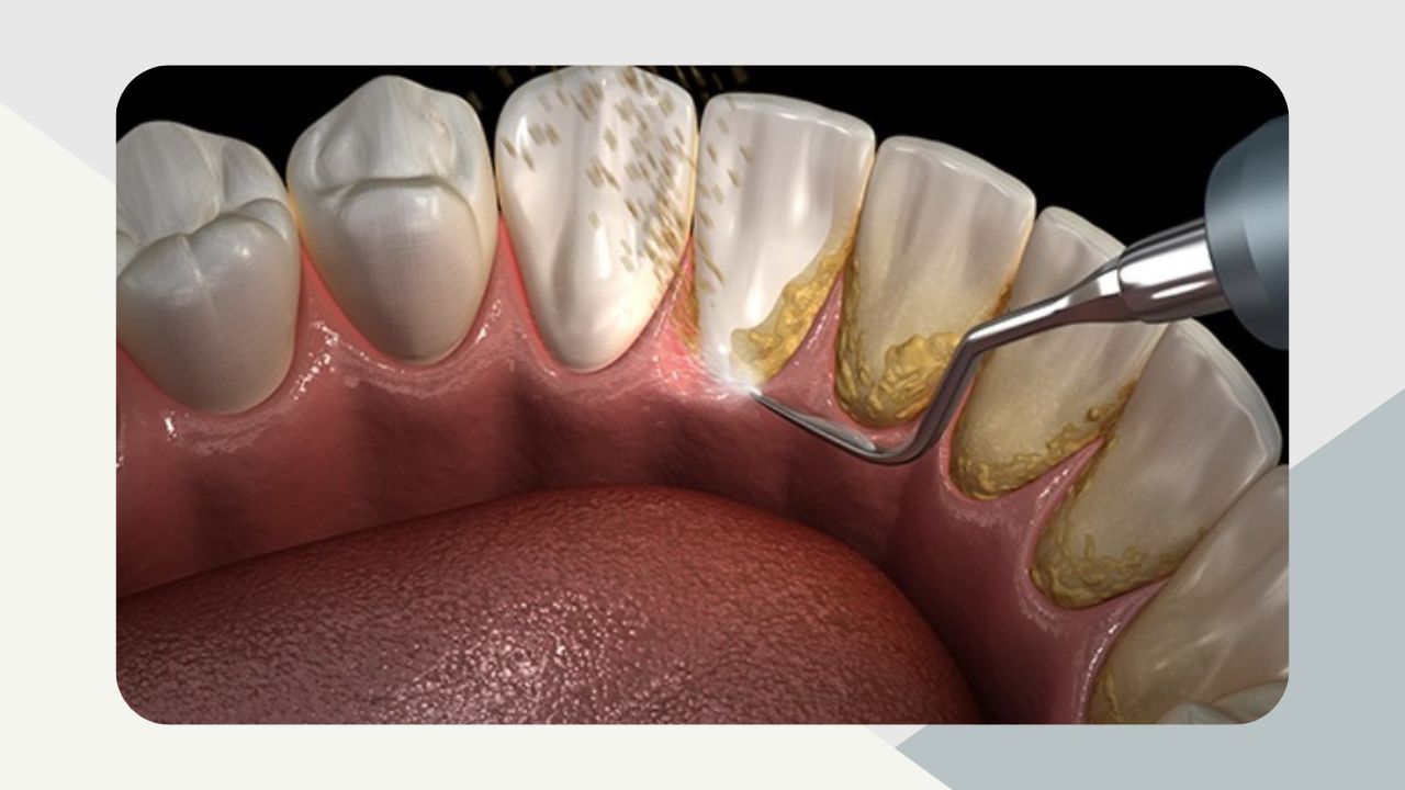 Periodontal Maintenance Cleaning