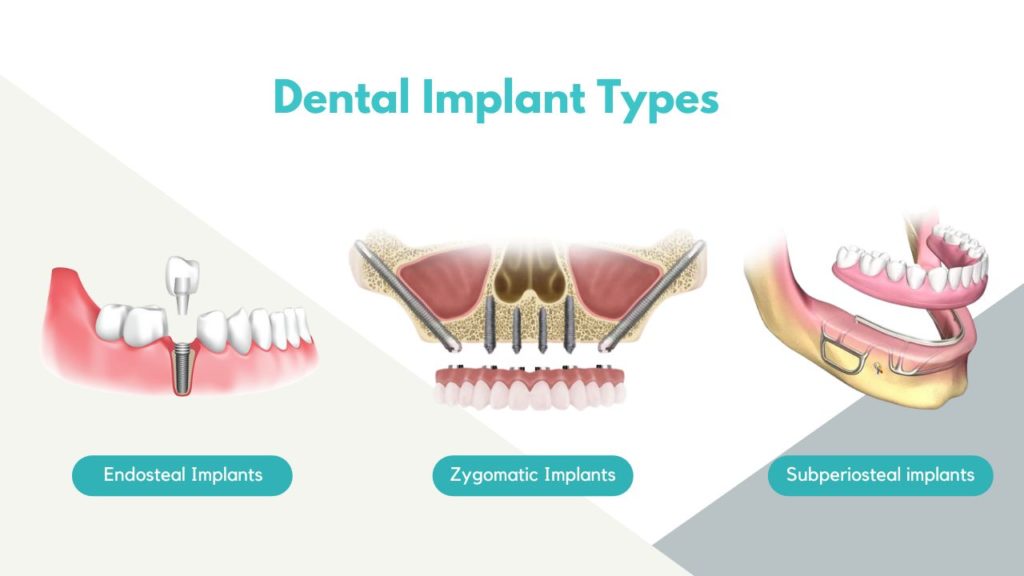 Dental Implant Types image