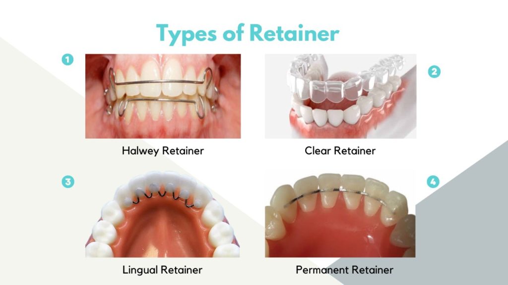Types of Retainer 1 image