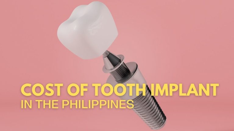 Cover Cost of Tooth Implant in Philippines