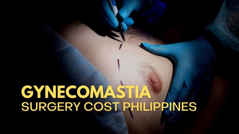 Cover Gynecomastia Surgery Cost in Philippines