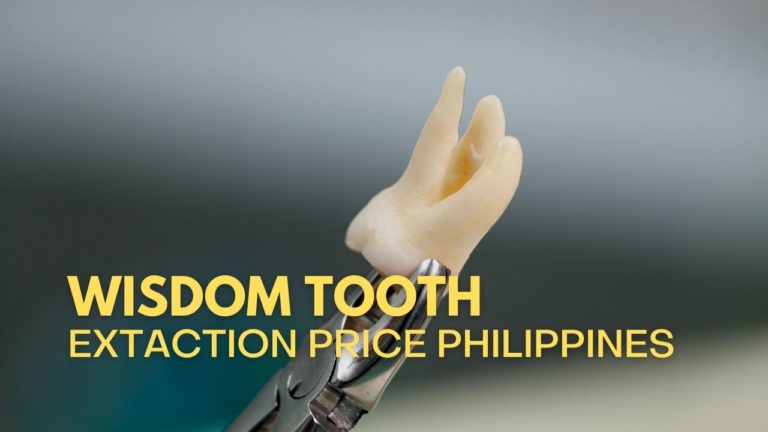 Cover Wisdom Tooth Extraction Cost in Philippines