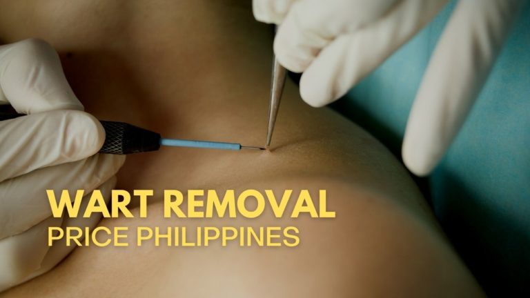 Cover Wart Removal Price in Philippines
