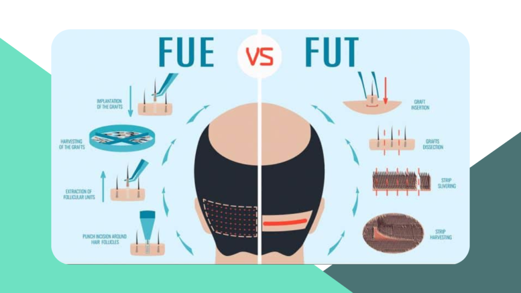Types hair transplant FUE vs FUT image